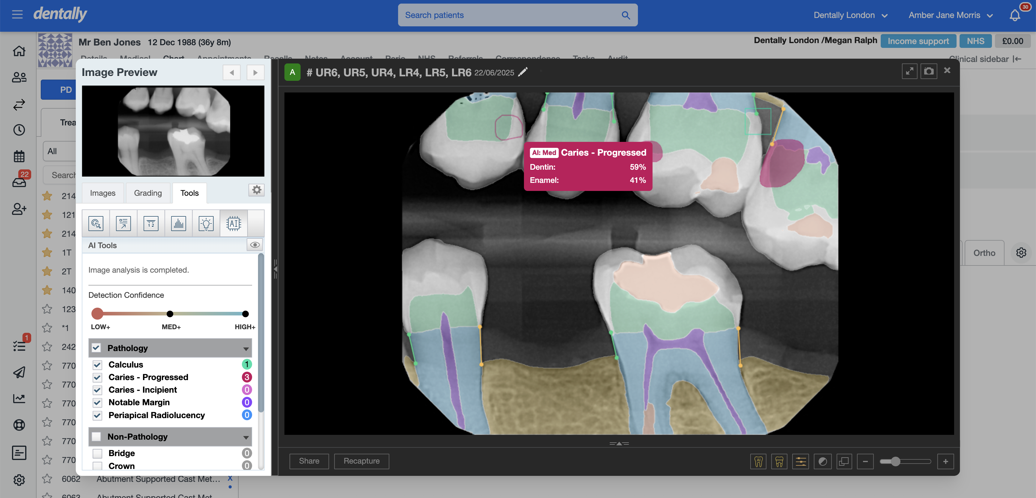 Dental bitewing X-ray with AI overlays
